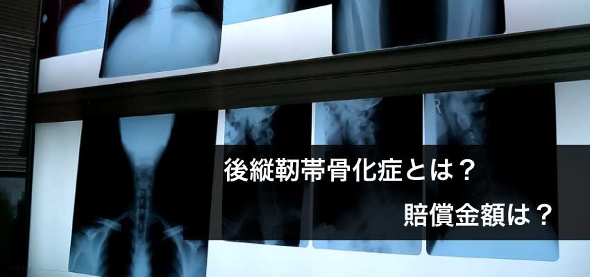 後縦靭帯骨化症とは 事故前から罹患と診断されると賠償金額は デイライト法律事務所