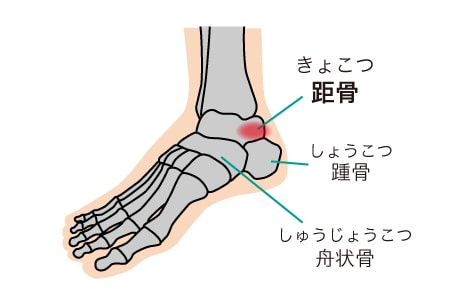 距骨骨折とは