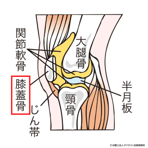 交通事故で膝蓋骨骨折 後遺障害や慰謝料の相場は デイライト法律事務所