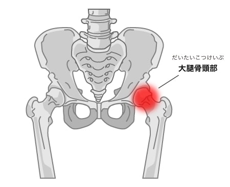 大腿骨頸部（だいたいこつけいぶ）骨折