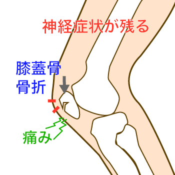 交通事故で膝蓋骨骨折 後遺障害や慰謝料の相場は デイライト法律事務所