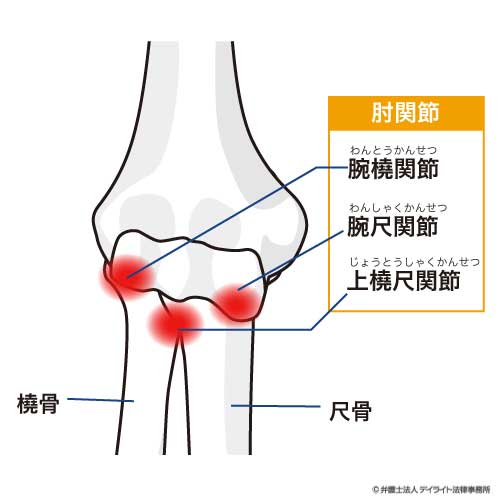 肘関節の可動域制限は 後遺障害の何級に該当しますか デイライト法律事務所