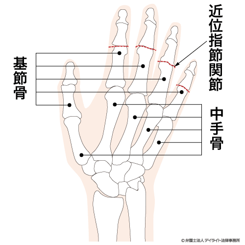 12級9号 1手の小指を失ったもの