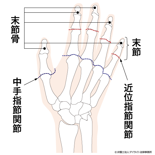 12級10号 1手のひとさし指、なか指又はくすり指の用を廃したもの