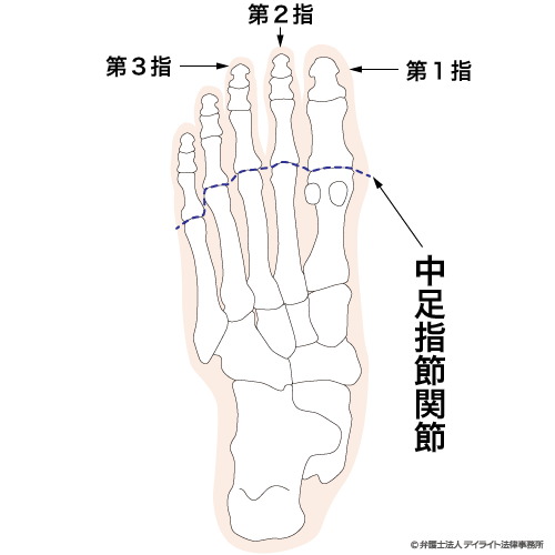 12級11号 1足の第2の足指を失ったもの、第2の足指を含み2の足指を失ったもの又は第3の足指以下の3の足指を失ったもの