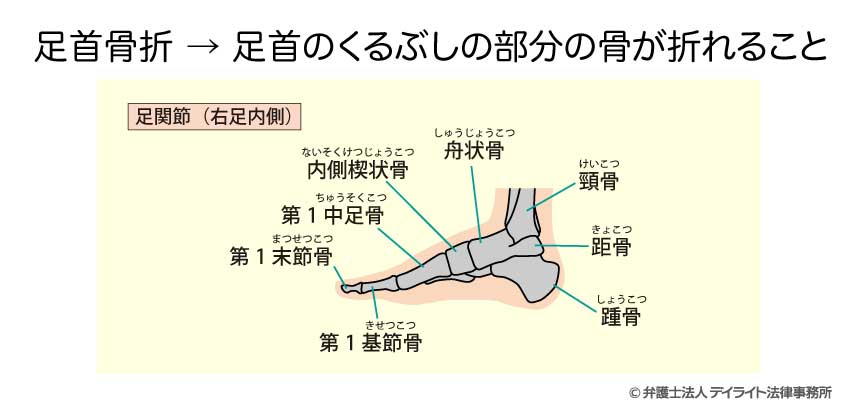 足首骨折（足関節骨折）