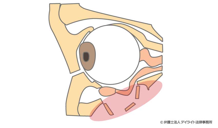 眼窩底骨折（眼底骨折）