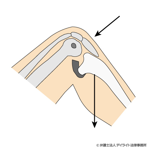 posterior sagテストのイメージ図