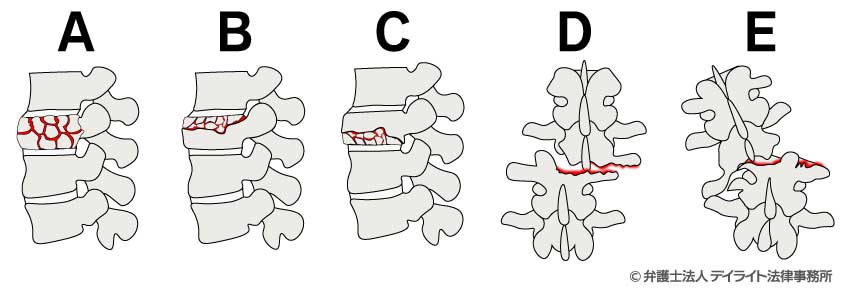 破裂骨折の分類