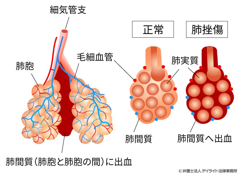 肺挫傷