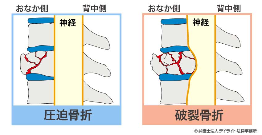 腰椎破裂骨折と腰椎圧迫骨折の違い