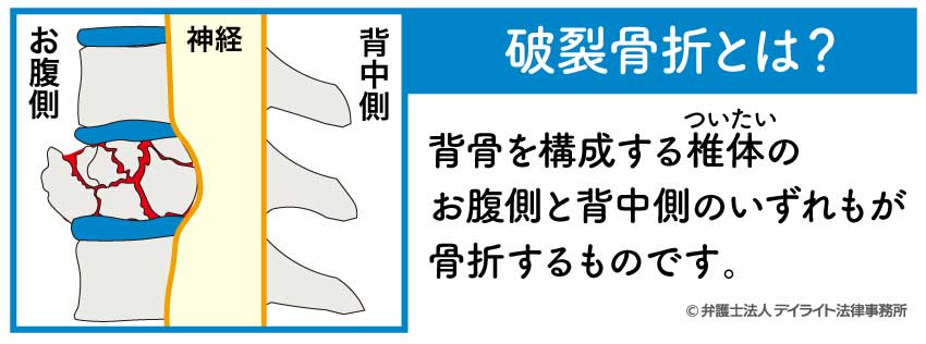 破裂骨折とは？