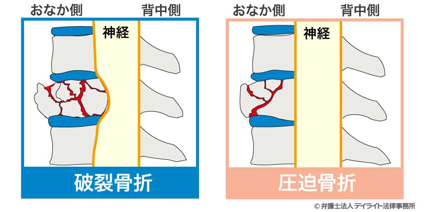 破裂骨折と圧迫骨折との違い