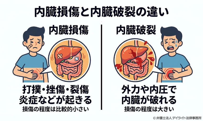 内蔵損傷との違い