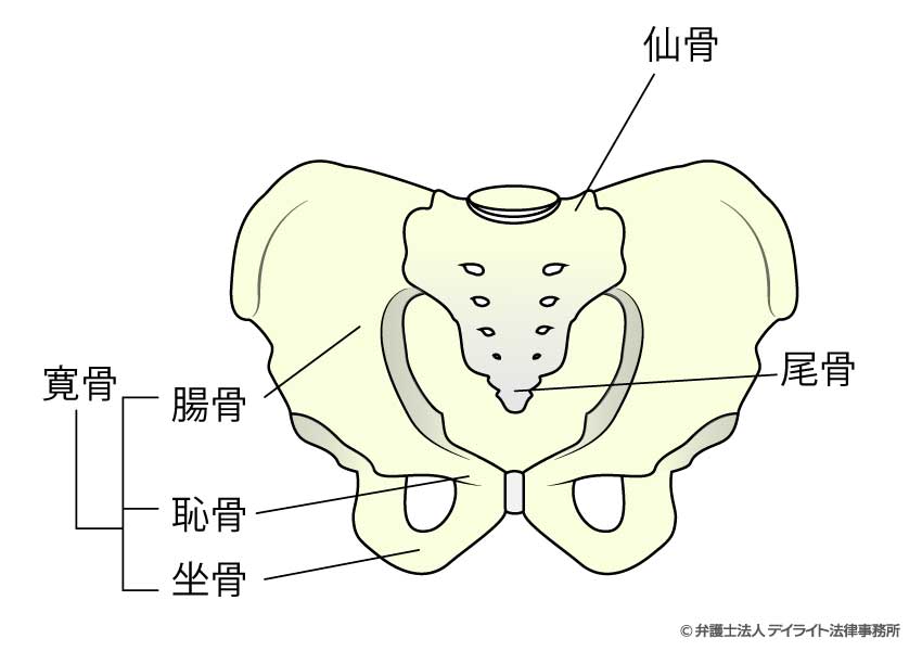 骨盤骨折による後遺症のポイント|弁護士が解説 | 交通事故の相談はデイライト法律事務所