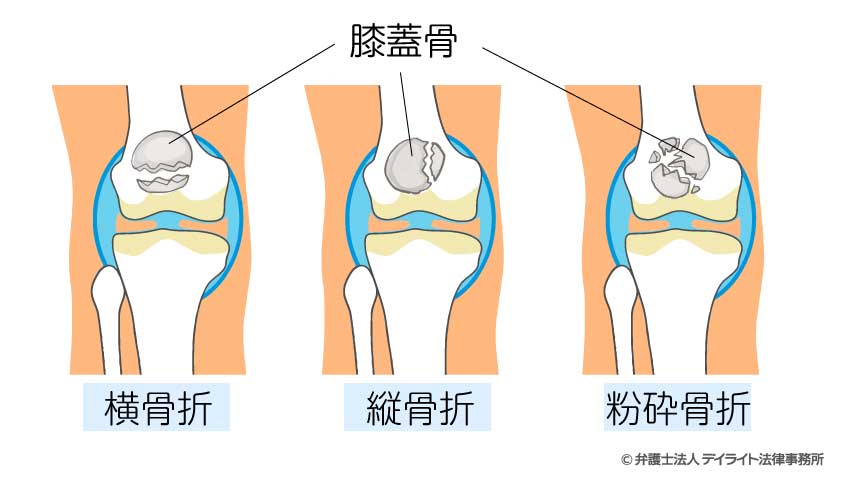 膝蓋骨骨折3つの骨折