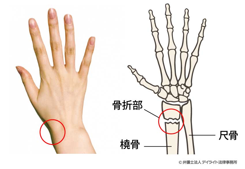 手首骨折（てくびこっせつ）とは、手首の部分にある骨が折れることをいいます
