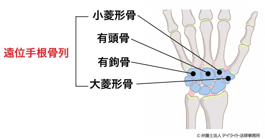 遠位手根骨列(手のひらに近い側の4個)