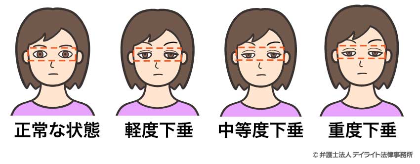 眼瞼下垂