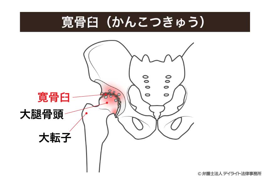 寛骨臼(かんこつきゅう)