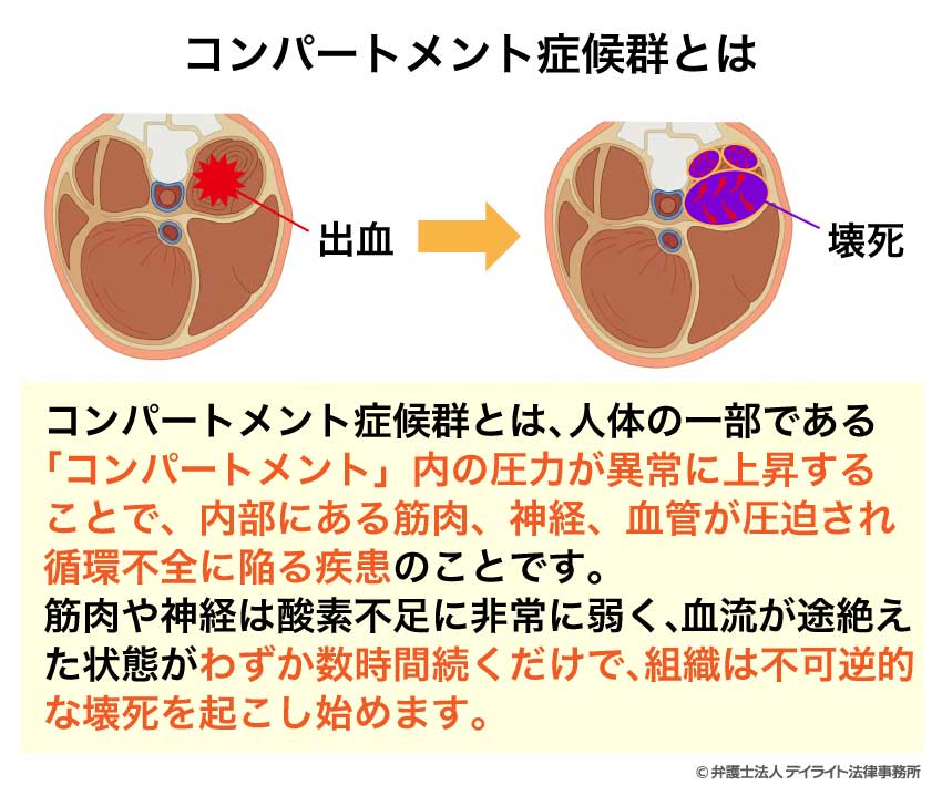コンパートメント症候群とは