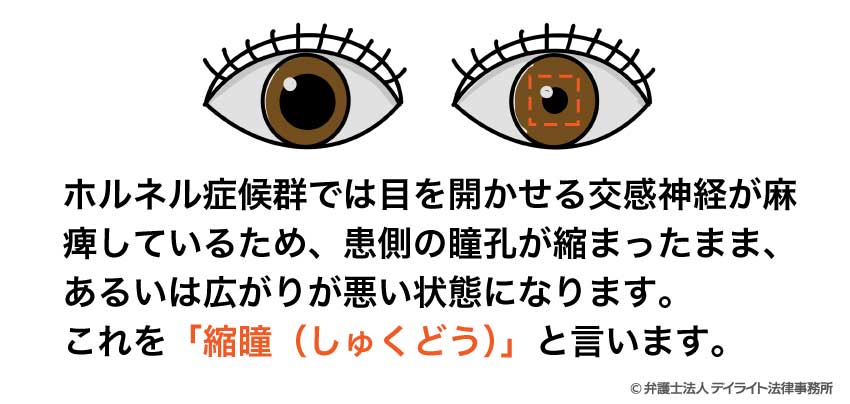 縮瞳(しゅくどう):瞳孔が小さくなる