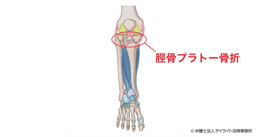 脛骨プラトー骨折