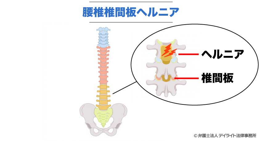 腰椎椎間板ヘルニア