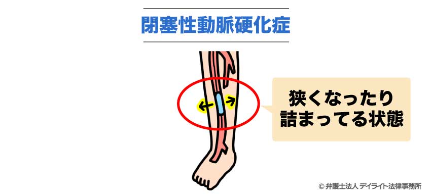 閉塞性動脈硬化症