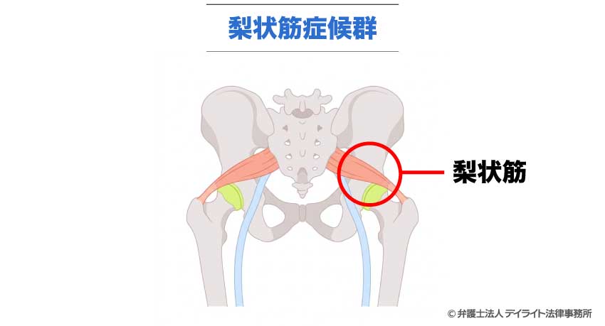 梨状筋症候群