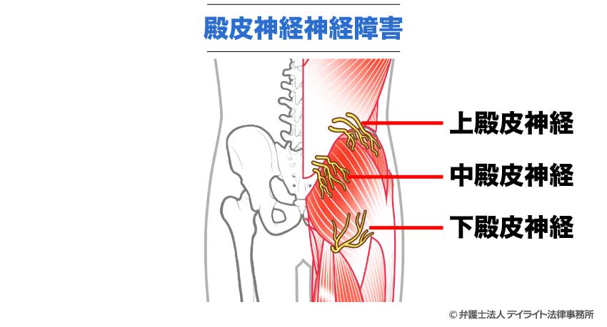殿皮神経障害