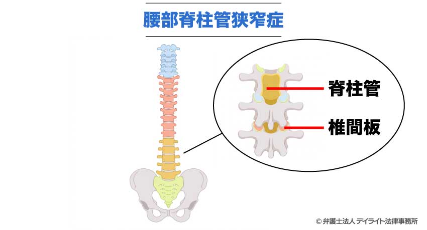 腰部脊柱管狭窄症