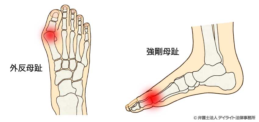 外反母趾・強剛母趾