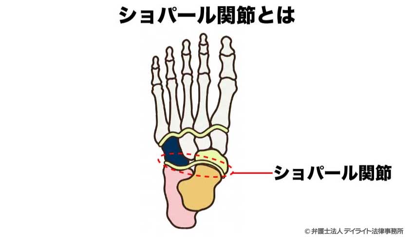 ショパール関節
