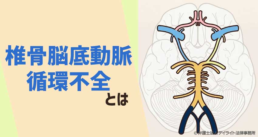 椎骨脳底動脈循環不全とは？症状・原因と正しい対処法