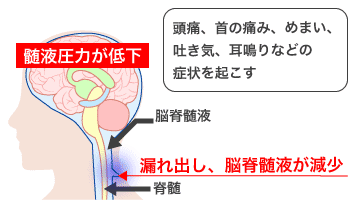 交通事故で脳脊髄液減少症 低髄液圧症候群 に 後遺症になる デイライト法律事務所