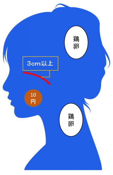 12級14号に該当する外貌醜状