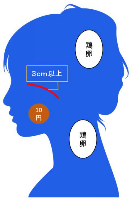 12級14号に該当する外貌醜状