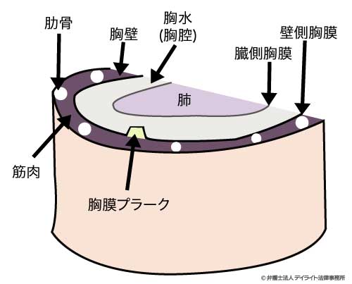 胸膜プラーク参考画像