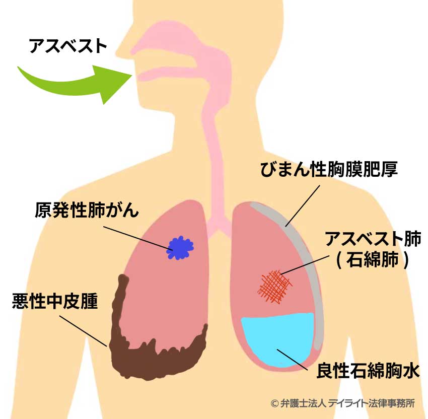 アスベストで発症する5つの病気