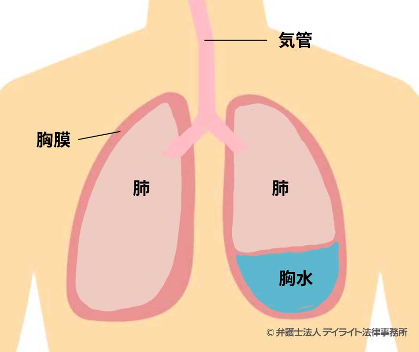 胸水とは