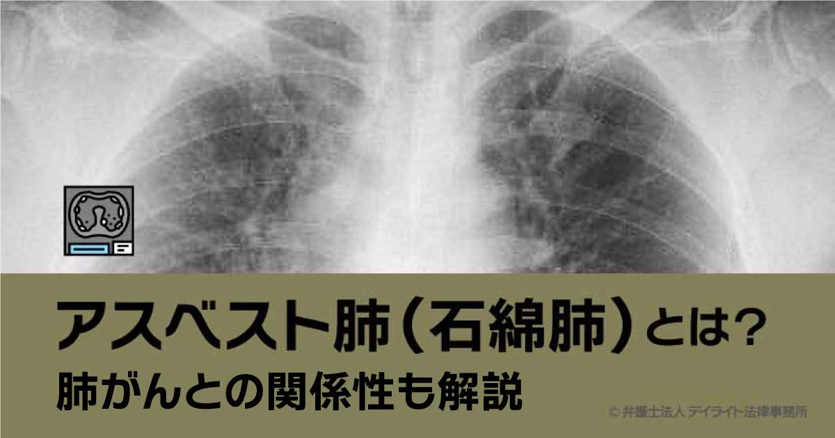 石綿肺の治療