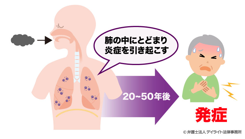 アスベストと肺炎の関係