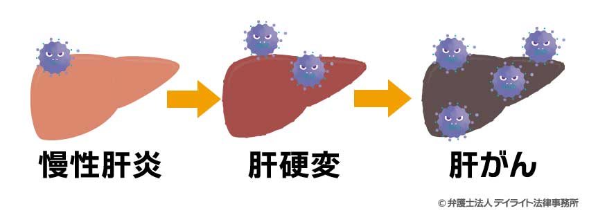 B型肝炎ウイルスの感染が持続した場合