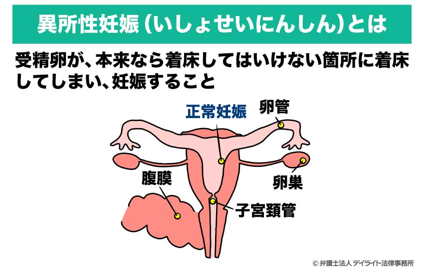 異所性妊娠とは?