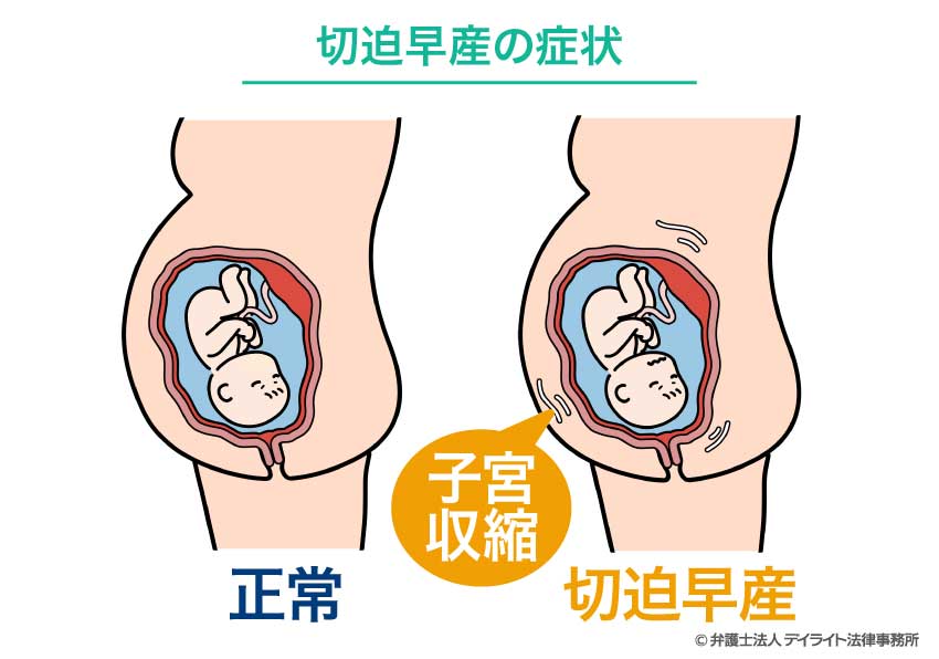 切迫早産の症状