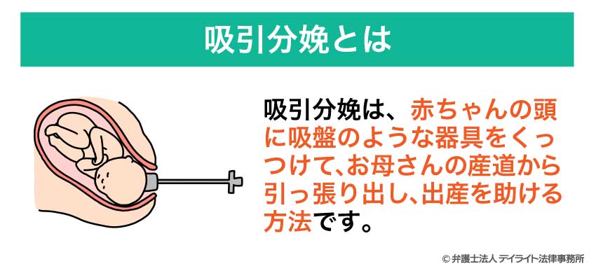 吸引分娩とは