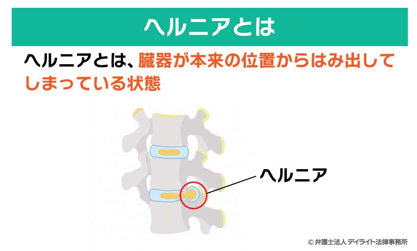ヘルニアとは